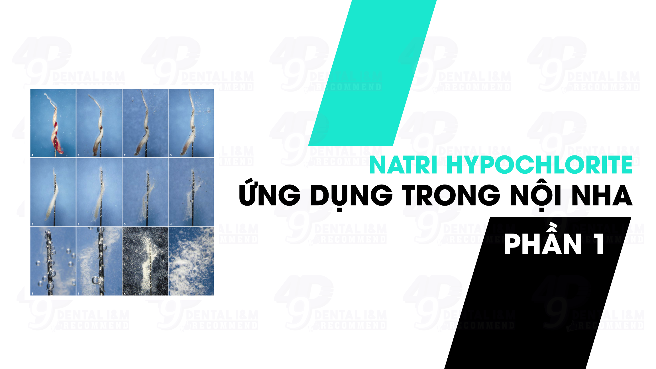 Natri Hypocloride (NaClO) và ứng dụng trong nội nha - P1
