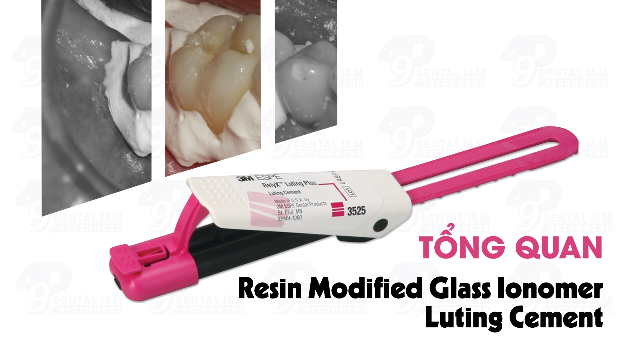 Cement nha khoa: Tổng quan Cement Resin Modified Glass Ionomer - RMGIs