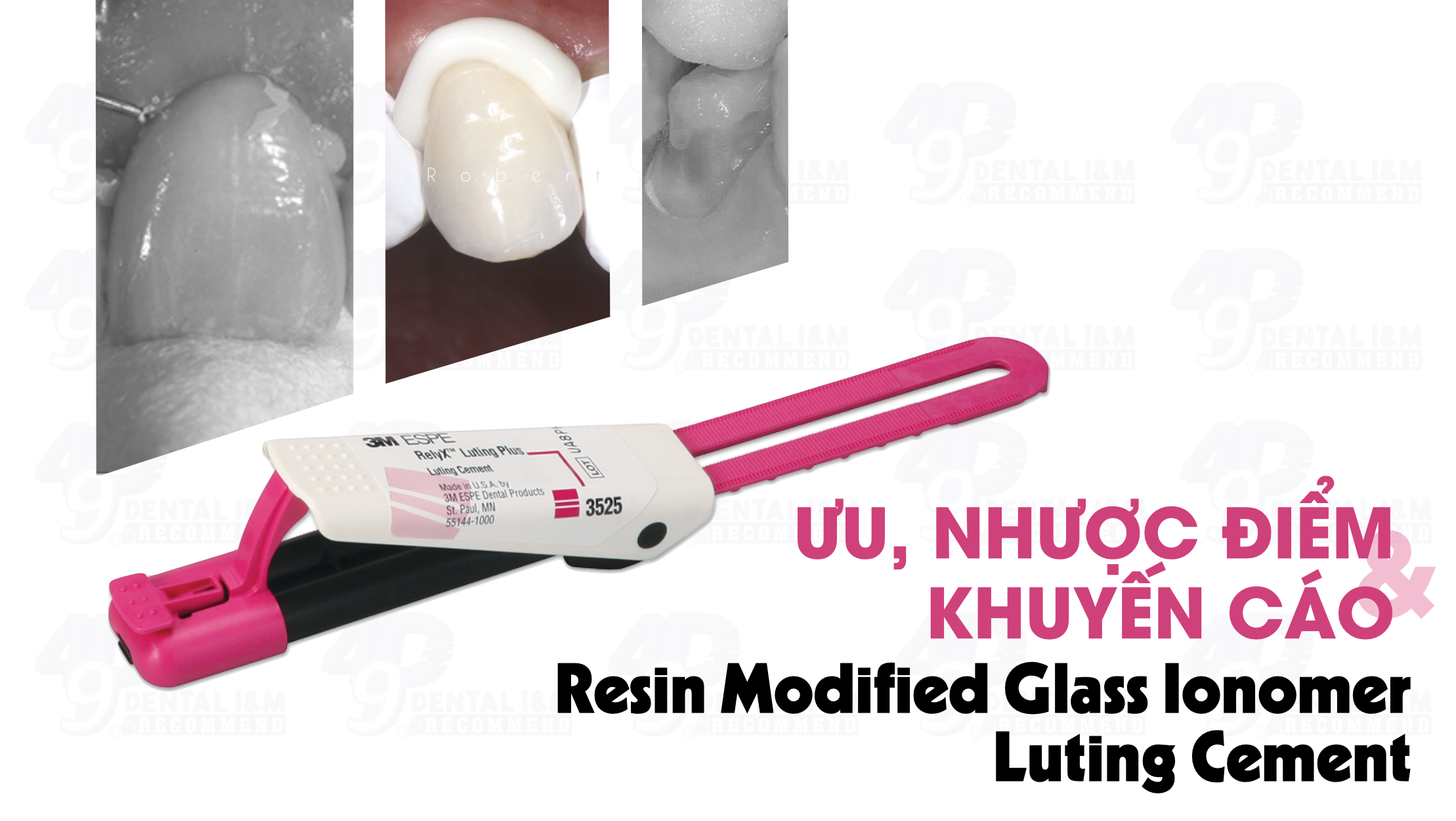 Cement nha khoa: Ưu, Nhược điểm của cement Resin Modified Glass Ionomer - RMGI