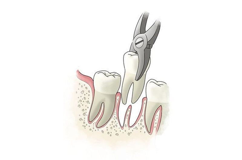 Nhổ răng? Tốt hơn là nên đọc bài báo này!