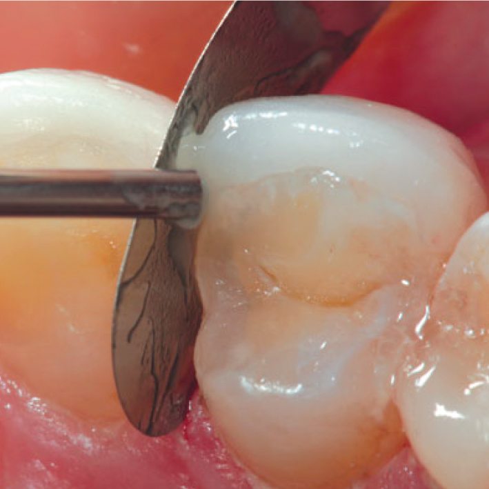 Composite lỏng Permaflo - Ultradent