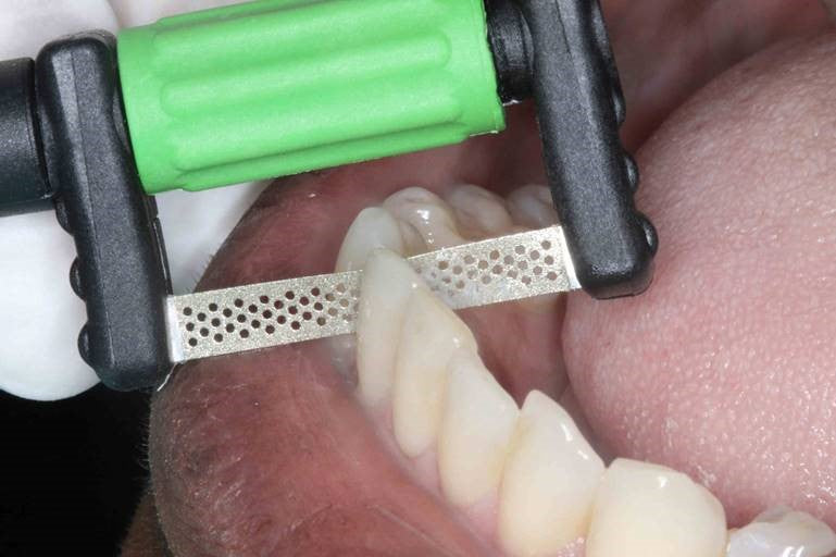 Bộ cắt kẽ và tạo hình cầm tay FitStrip™ chỉnh nha - Garrision