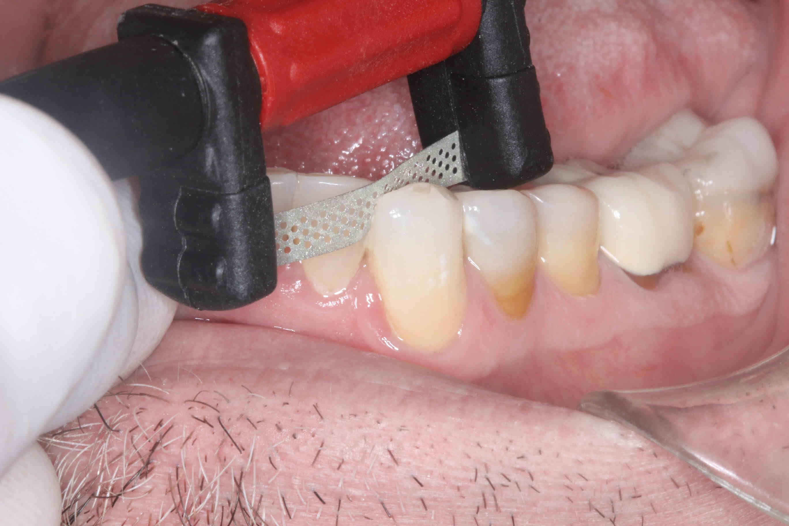 Bộ cắt kẽ và tạo hình cầm tay FitStrip™ chỉnh nha - Garrision