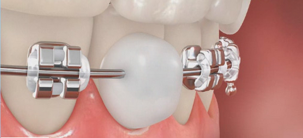 sáp-chỉnh-nha-piksters-49p.vn