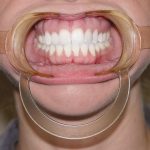 banh-má-hai-bên-ortho-technology-49p.vn