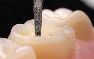 Bộ mũi mài Onlay mặt nhai 4665 - Komet