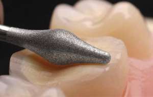 Bộ mũi mài Onlay mặt nhai 4665 - Komet