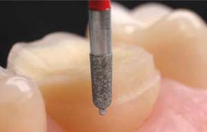 Bộ mũi mài Onlay mặt nhai 4665 - Komet