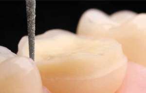 Bộ mũi mài Onlay mặt nhai 4665 - Komet