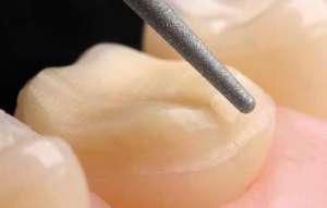 Bộ mũi mài Onlay mặt nhai 4665 - Komet