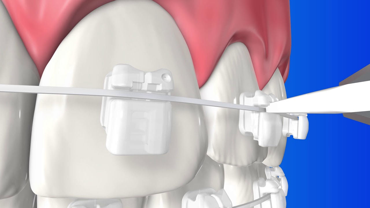 Mắc cài sứ tự buộc Clarity Ultra - 3M