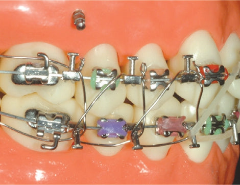 Hook chỉnh nha - Dentos