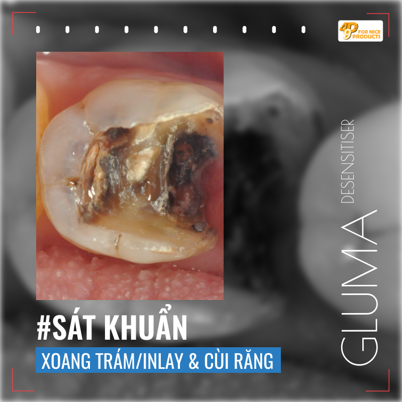 dung-dịch-sát-trùng-xoang,-chống-ê-buốt---gluma---kulzer-49p.vn