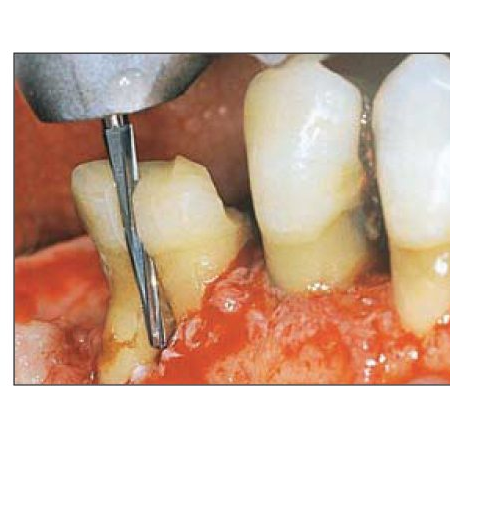 Mũi khoan phẫu thuật Surgery Burs - NTI