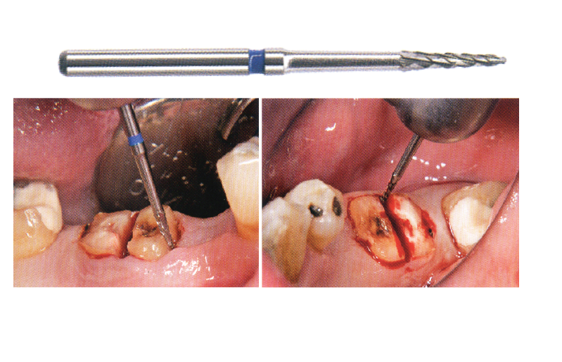 Mũi khoan phẫu thuật Surgery Burs - NTI