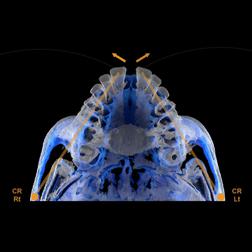 Hàm nong nhanh khẩu cái hỗ trợ bởi các minivis MSE ( Maxillary Skeletal Expander) - BioMaterials Korea