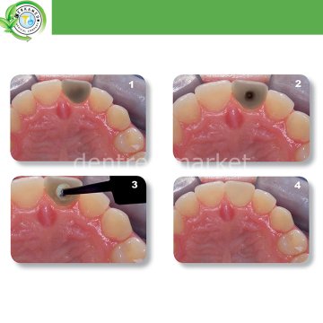 Thuốc tẩy trắng ống tủy bị đổi màu Endo-White - Cerkamed