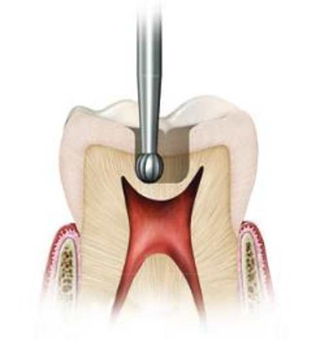 mũi-khoan-mài-xương-đầu-tròn-49p.vn