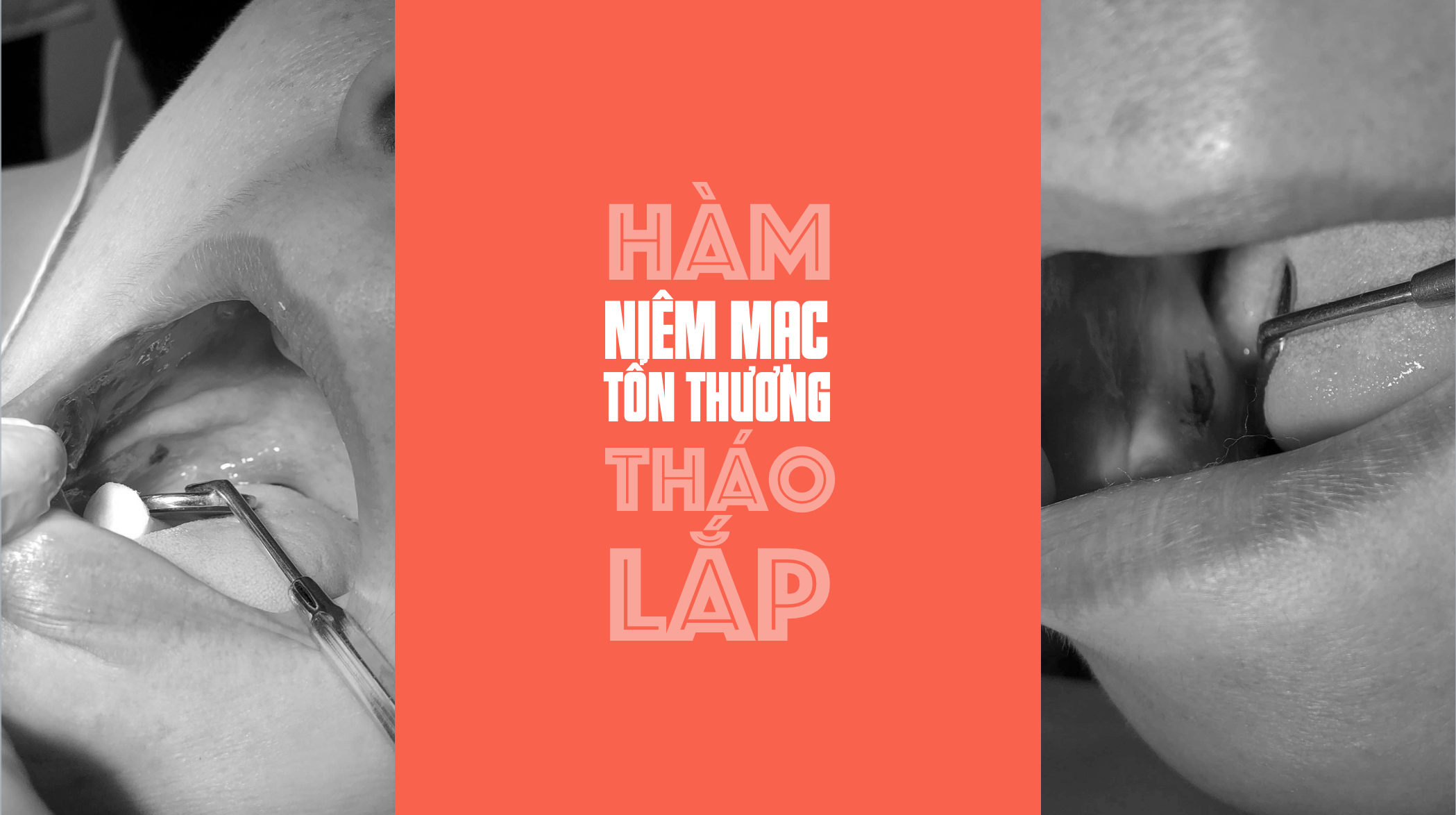 Những tổn thương niêm mạc do [HÀM THÁO LẮP]