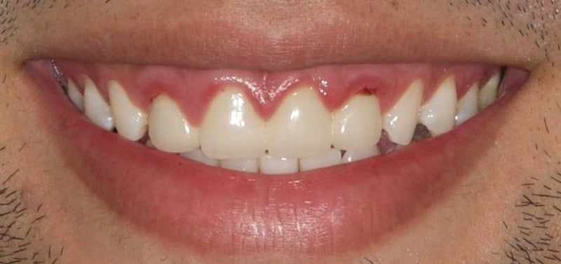 Quy trình thực hiện mão răng - Phần 4: Nụ cười khoảng sinh học