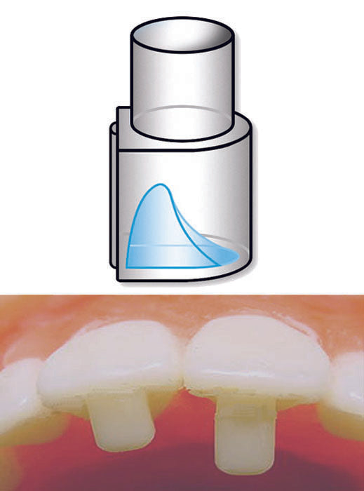 Khuôn tạo nâng khớp răng cửa Bite Ramp Bonder - Dynaflex