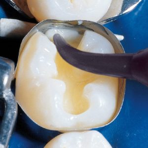 Composite lỏng  Permaflo - Ultradent
