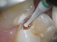 Mũi nạo ngà Cerabur K1SM - Komet