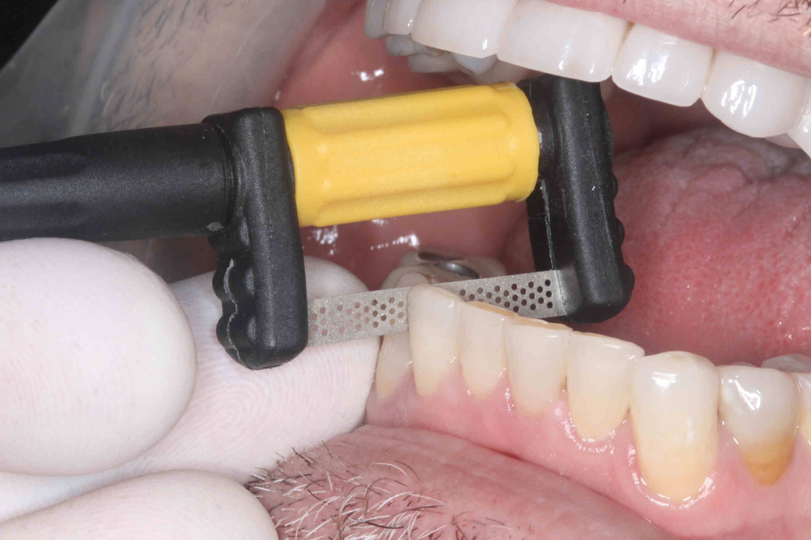 Bộ cắt kẽ và tạo hình cầm tay FitStrip™ chỉnh nha - Garrision