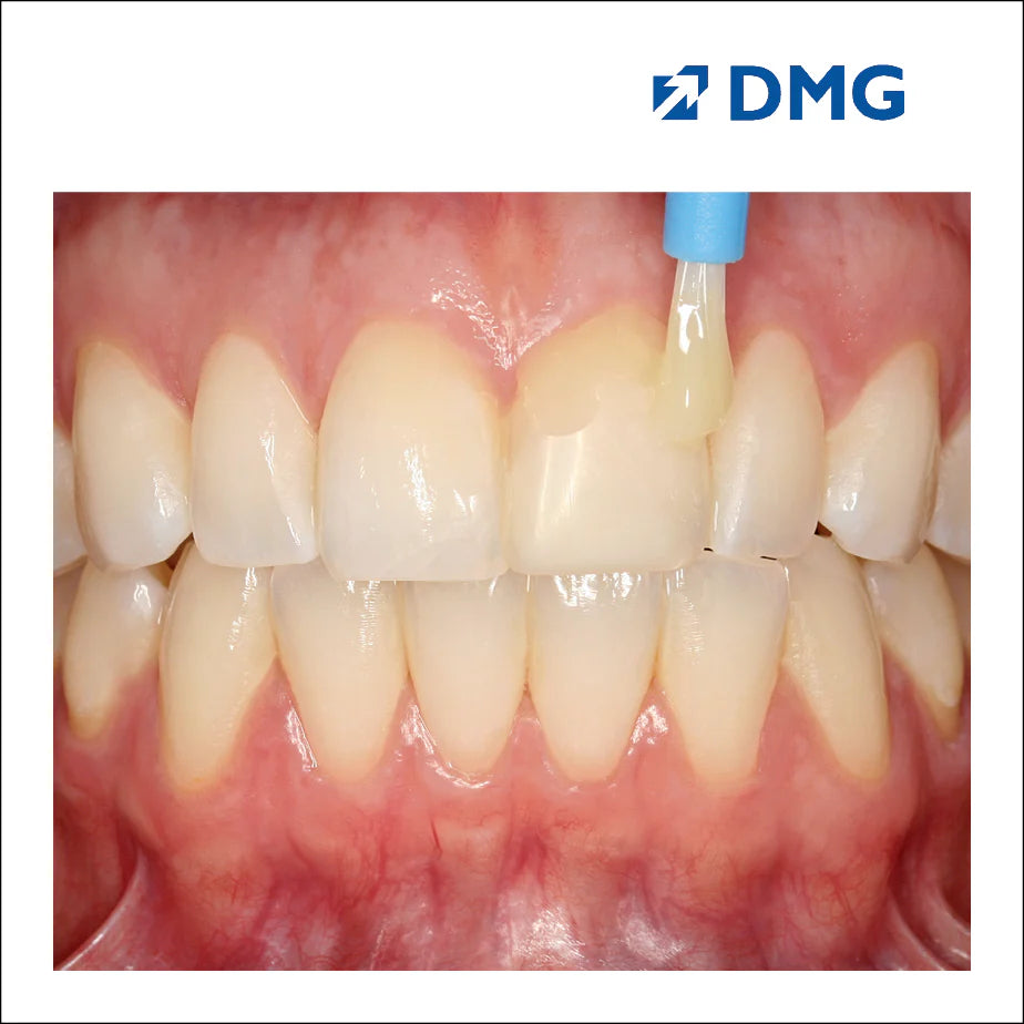 Vecni dự phòng sâu răng Flairesse - DMG