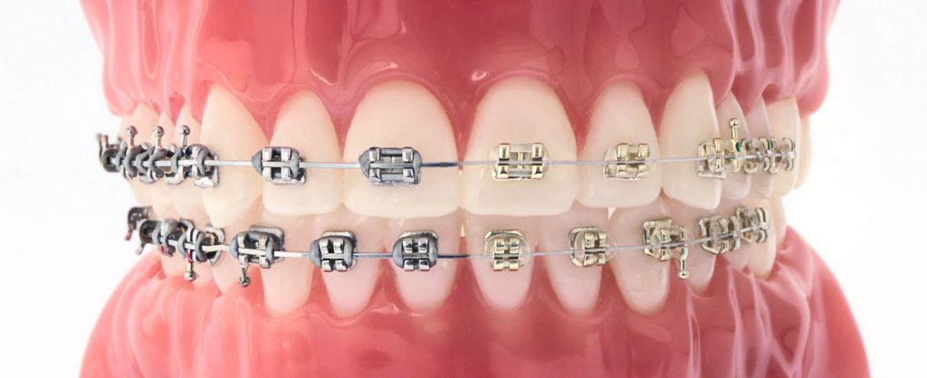 mắc-cài-vàng-iconix---american-orthodontics-49p.vn