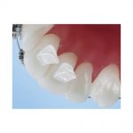 miếng-nâng-khớp-răng-trước---ortho-technology-49p.vn