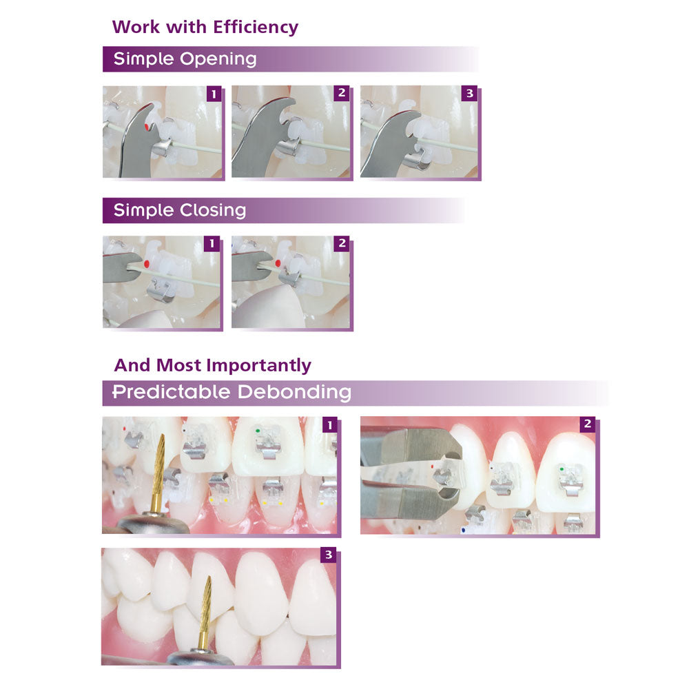 Mắc cài sứ tự buộc SensationM - Ortho Technology