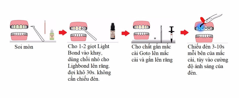 Composite gắn mắc cài Goto - Reliance