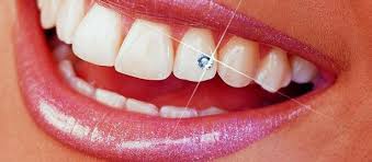 skyce-–-kim-cƯƠng-ĐÍnh-rĂng-ivoclar-vivadent-49p.vn