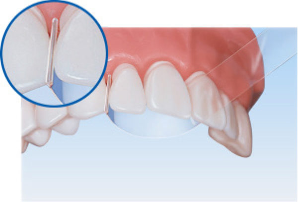 Đai trám trong suốt Directa®  Strips - Directa