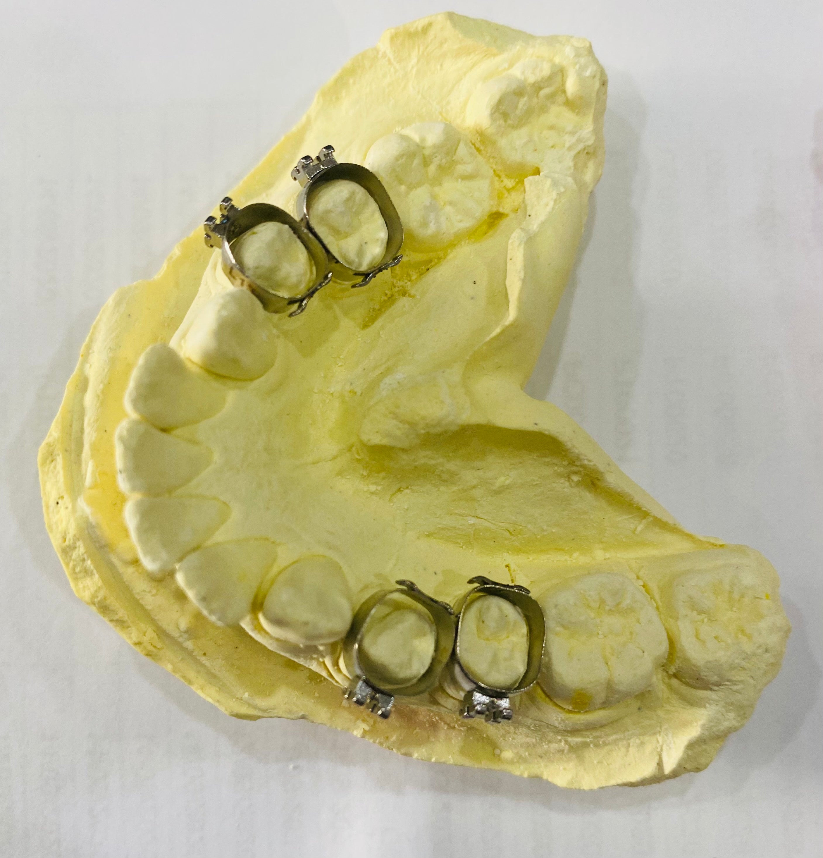 Khâu đơn răng 4, răng 5 - Ortho Technology