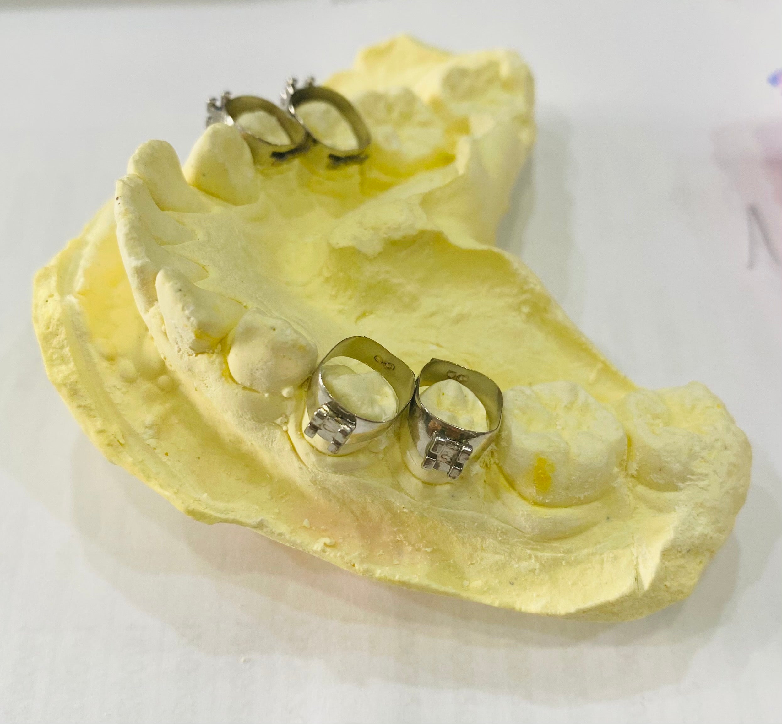 Khâu đơn răng 4, răng 5 - Ortho Technology