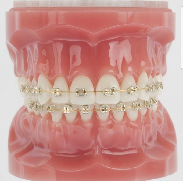 mắc-cài-vàng-iconix---american-orthodontics-49p.vn