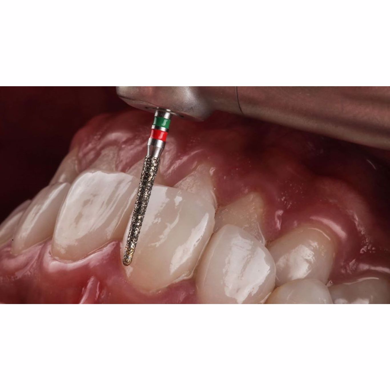 Mũi khoan sửa soạn Veneer 2 độ thô 6844 - Komet